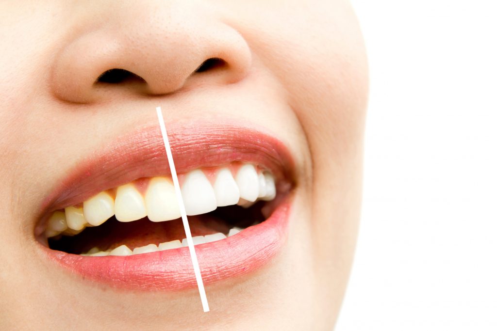 glossario odontoiatria estetica a Varese