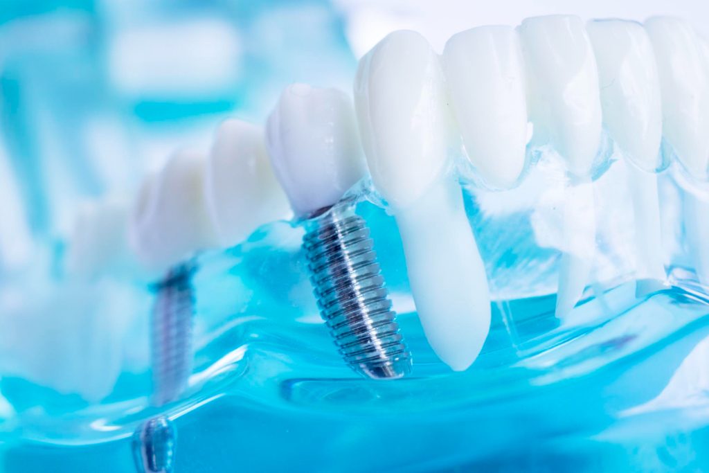 Perché un impianto dentale può cadere?