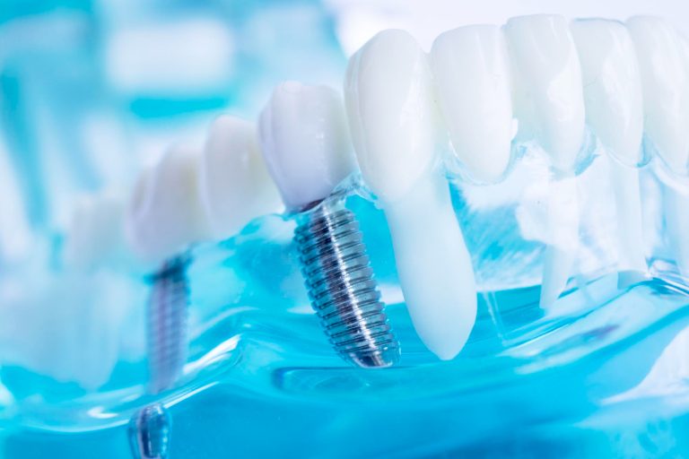 Perché un impianto dentale può cadere? Perché un impianto dentale può cadere?