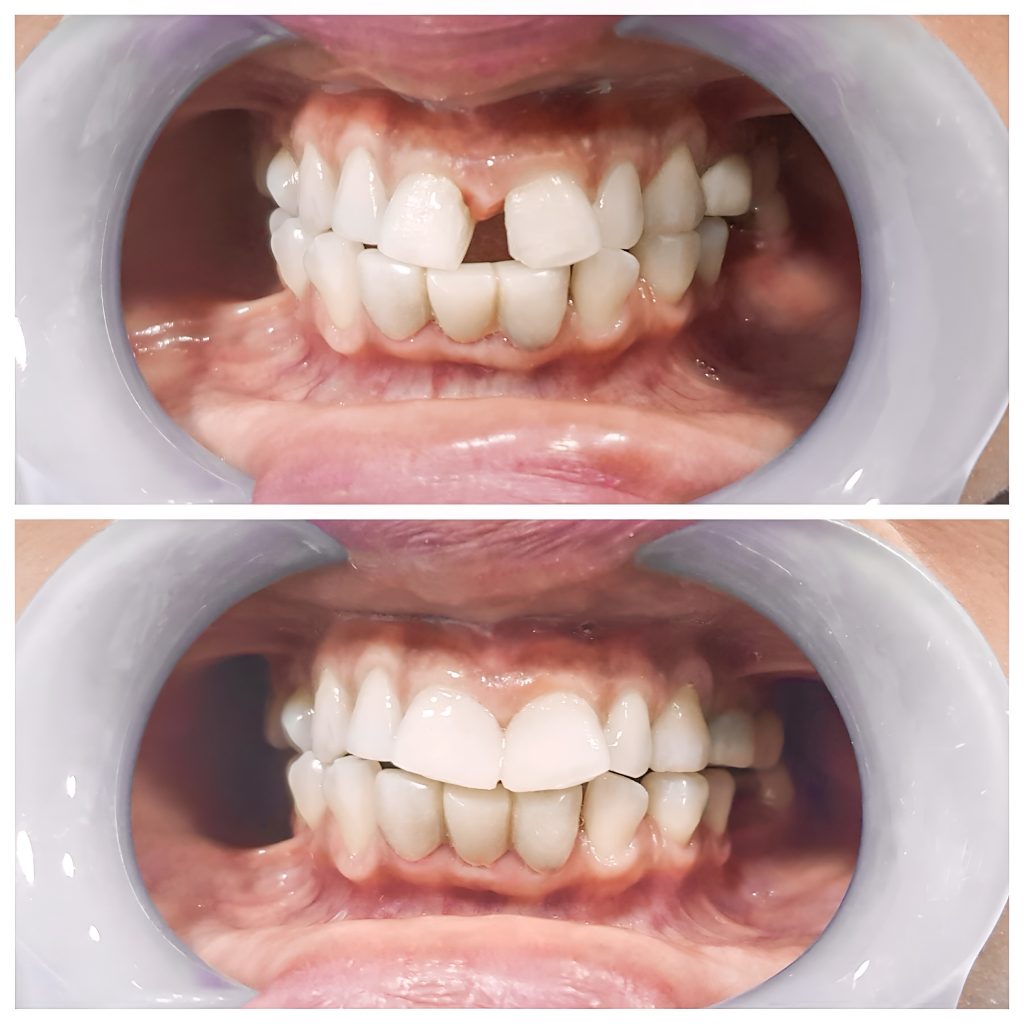 Correzione del diastema con apparecchio trasparente: come chiudere lo spazio tra i denti 1 Correzione del diastema con apparecchio trasparente