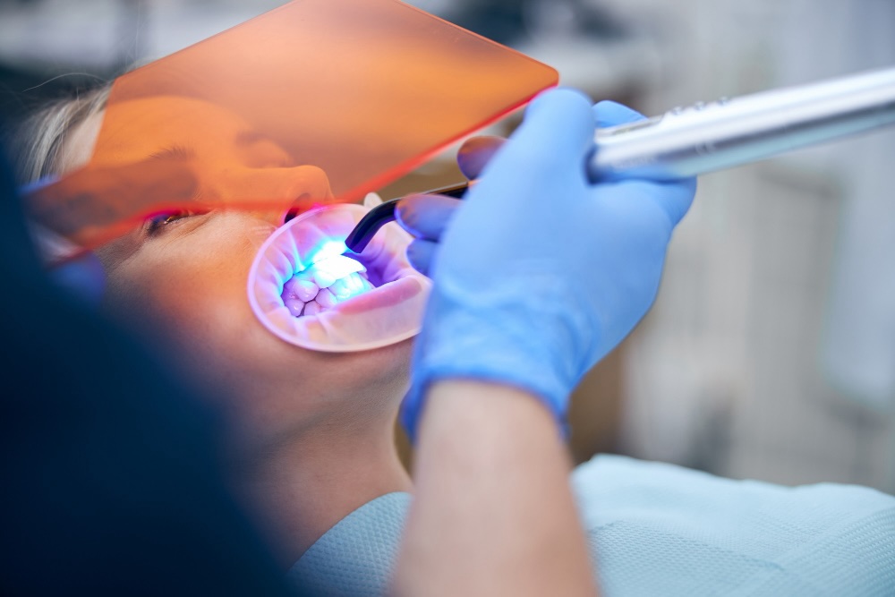 Durata dello sbiancamento LED: quanto dura il risultato e come farlo durare più a lungo 1 durata dello sbiancamento LED